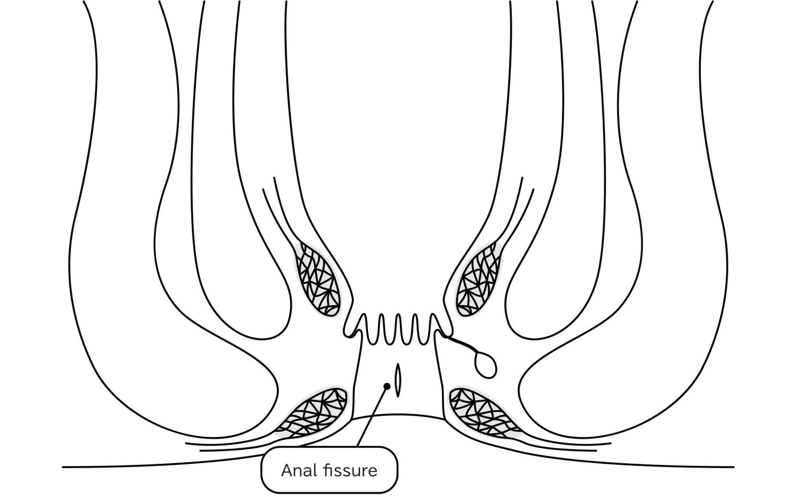 Fissure
