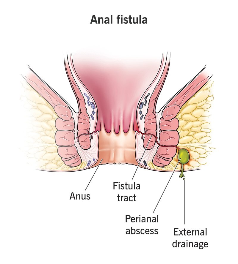best fistula surgeon in Kolkata