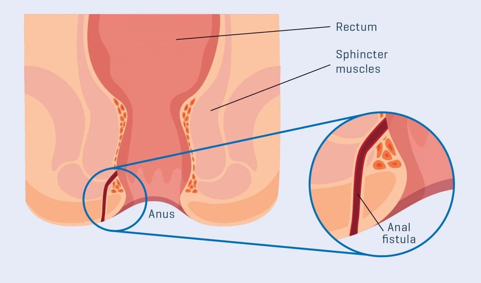 Fistula
