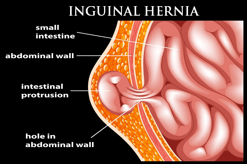 best hernia surgeon in kolkata