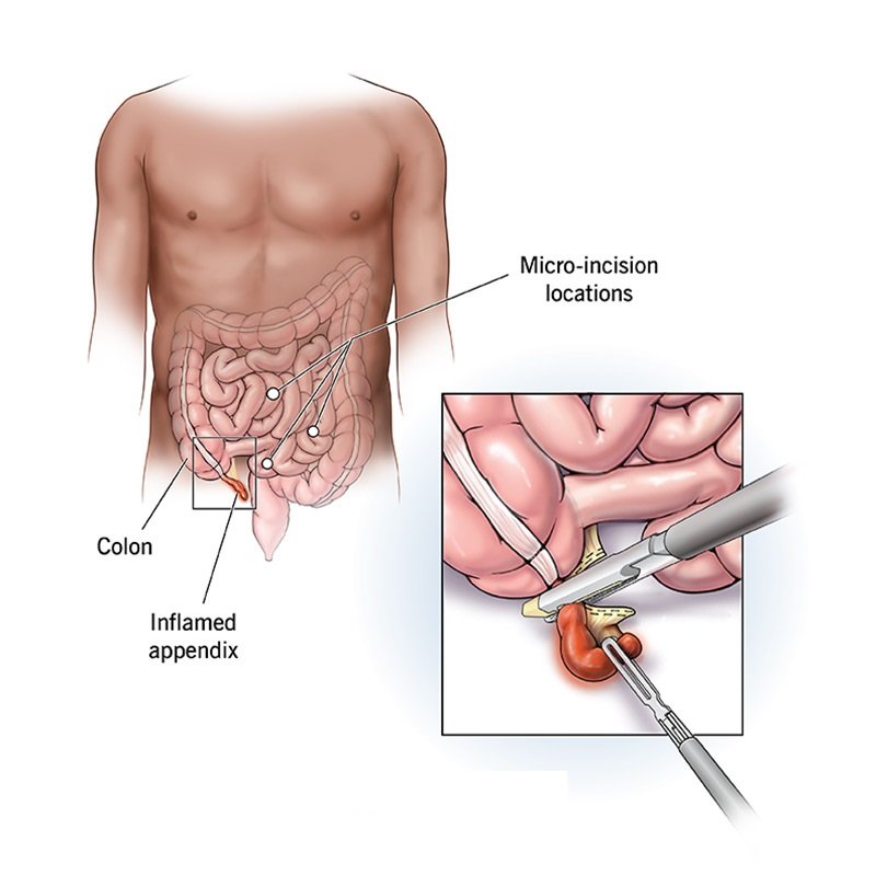 Laparoscopic Appendix Surgery