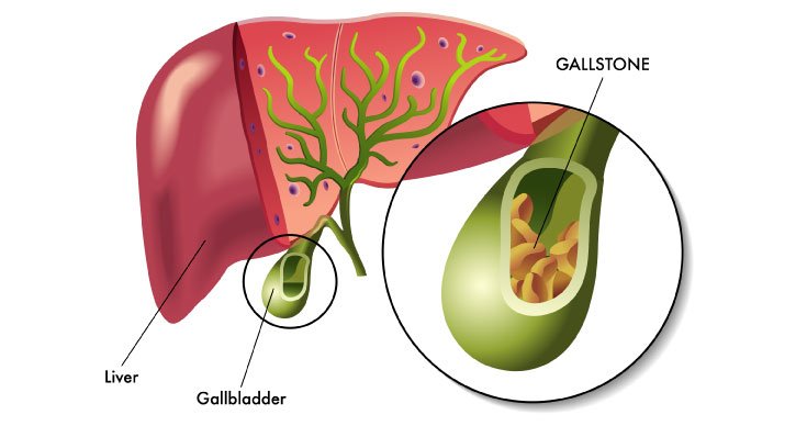 Gallbladder Stone Surgery