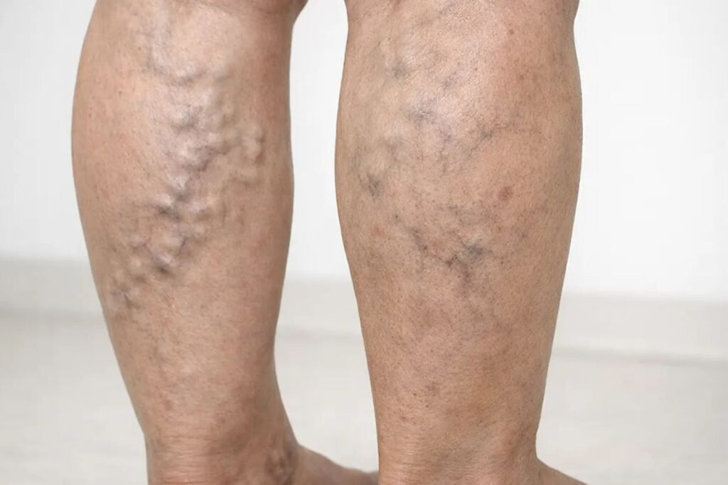 Varicose veins