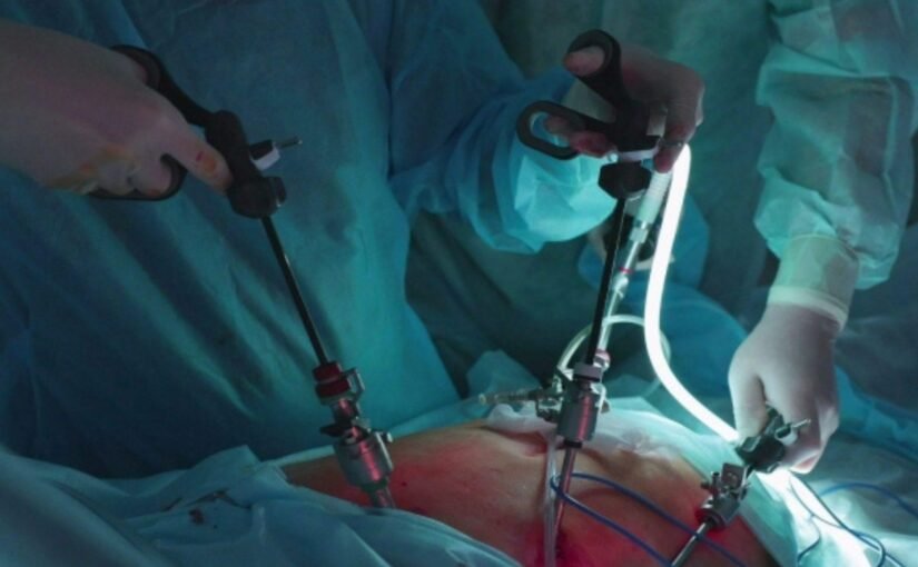Laparoscopic Cholecystectomy: A Patient’s Complete Guide to Gallbladder Stone Surgery