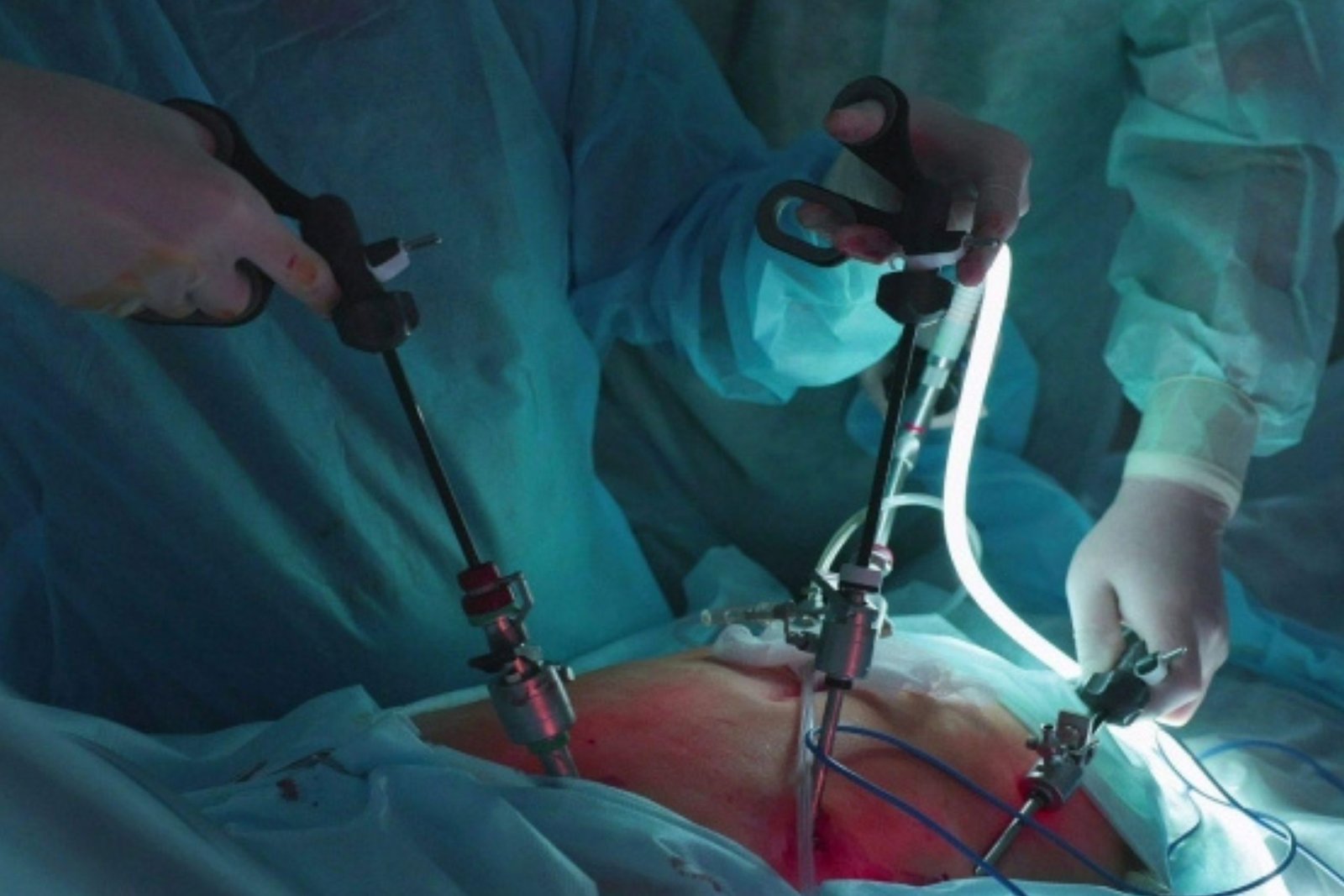 Laparoscopic Cholecystectomy: A Patient’s Complete Guide to Gallbladder Stone Surgery