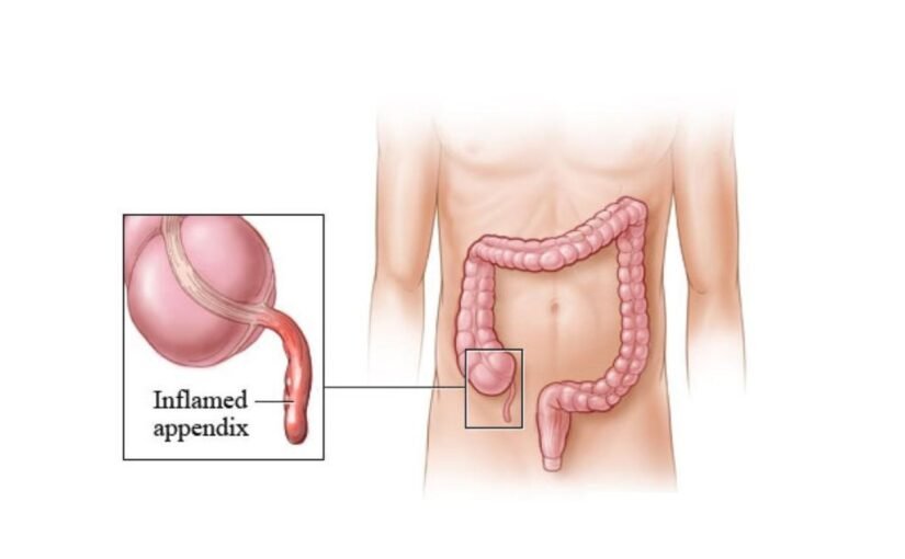 Appendix Surgery (Appendicectomy): A Complete Patient Guide