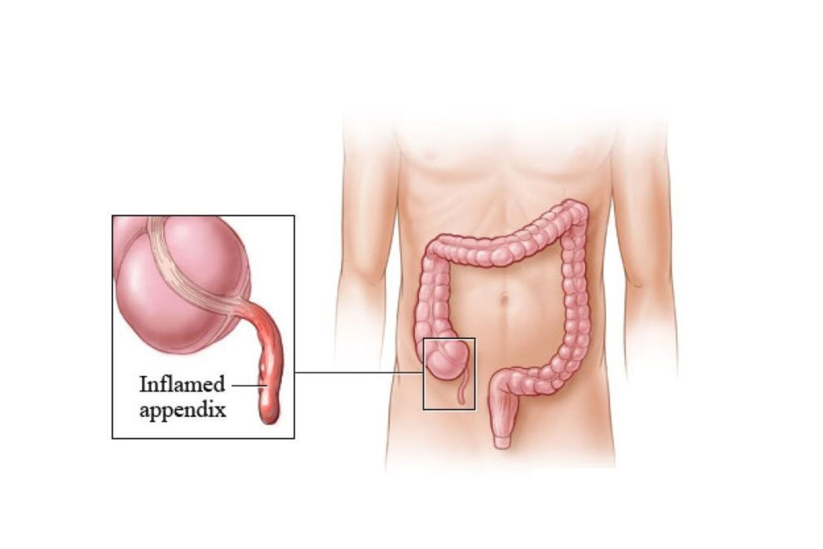 Appendix Surgery (Appendicectomy): A Complete Patient Guide