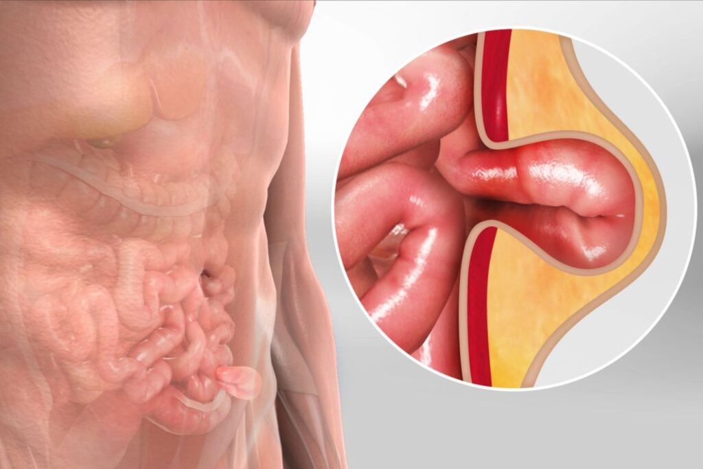 Hernia surgery