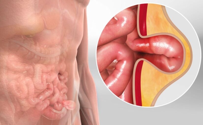 Inguinal Hernia Surgery: A Complete Patient Guide