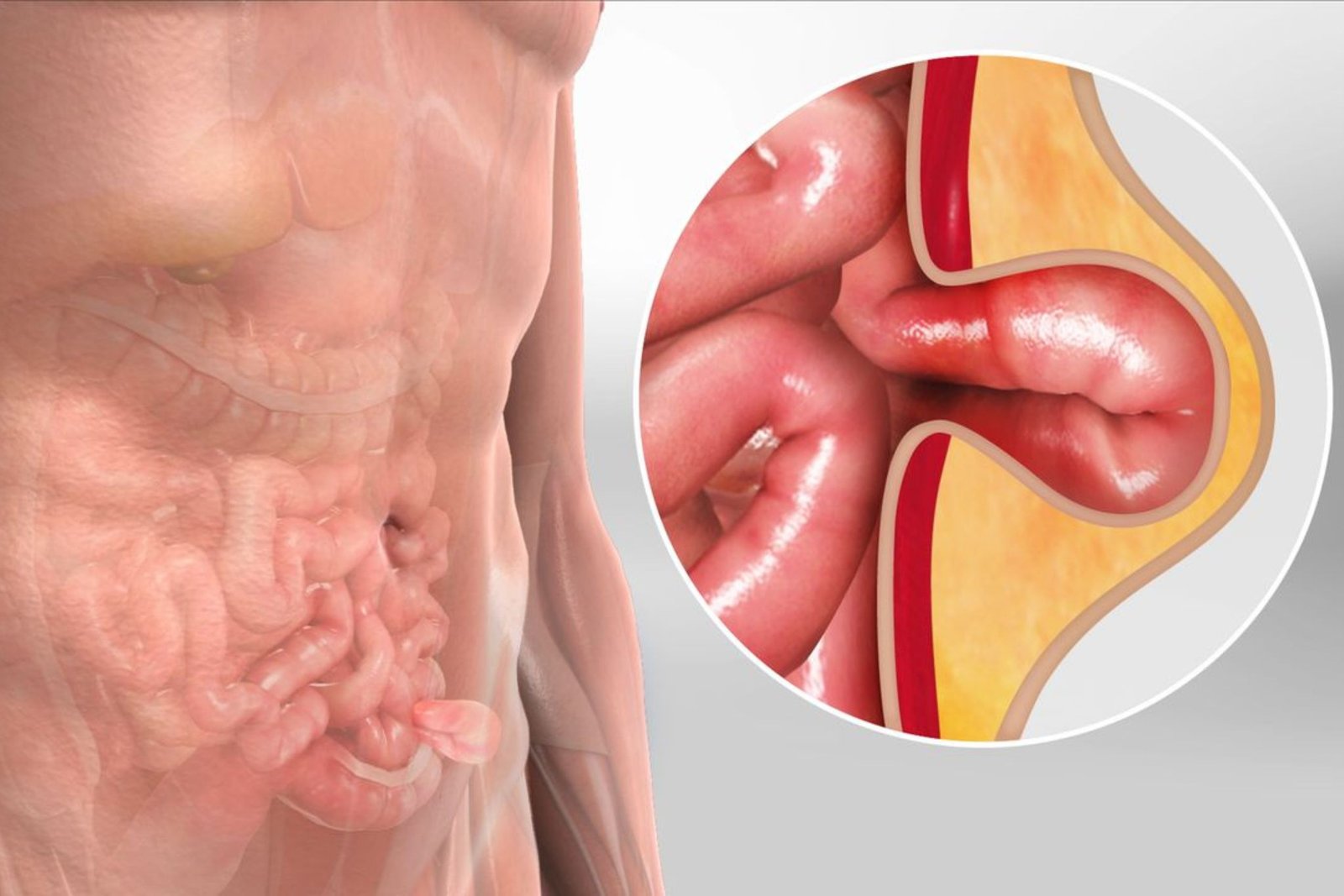 Inguinal Hernia Surgery: A Complete Patient Guide