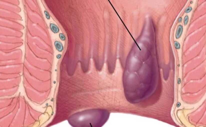 Piles (Haemorrhoids): A Complete Patient Guide to Non-Surgical and Surgical Treatment