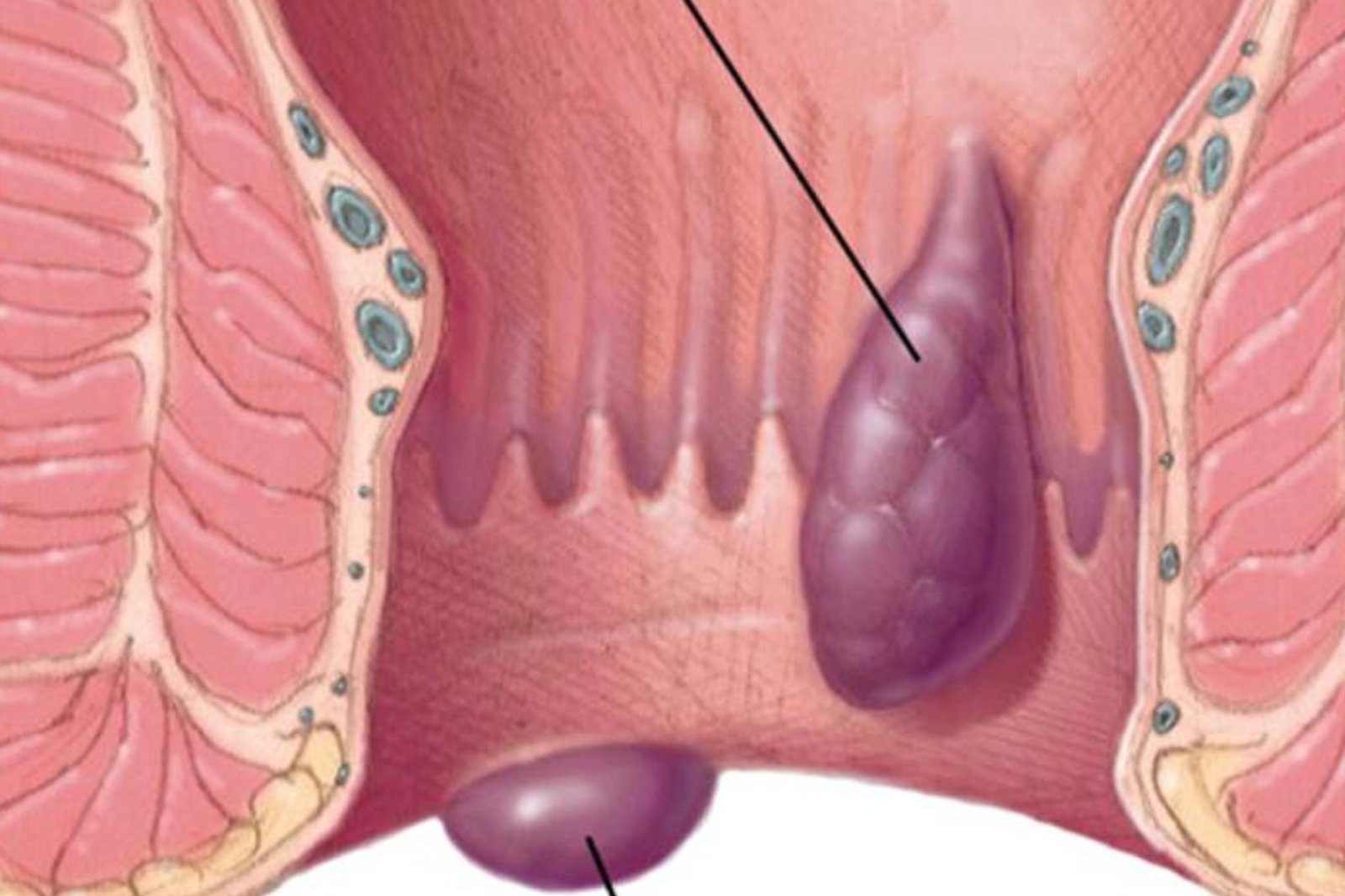 Piles (Haemorrhoids): A Complete Patient Guide to Non-Surgical and Surgical Treatment