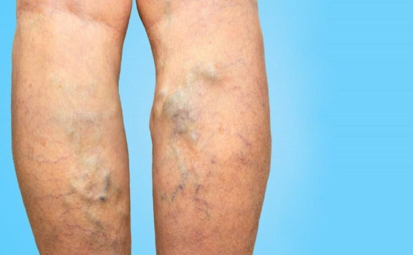 Varicose Veins: A Complete Patient Education Guide