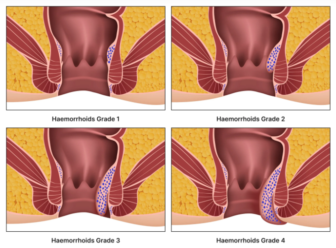 piles surgery in kolkata