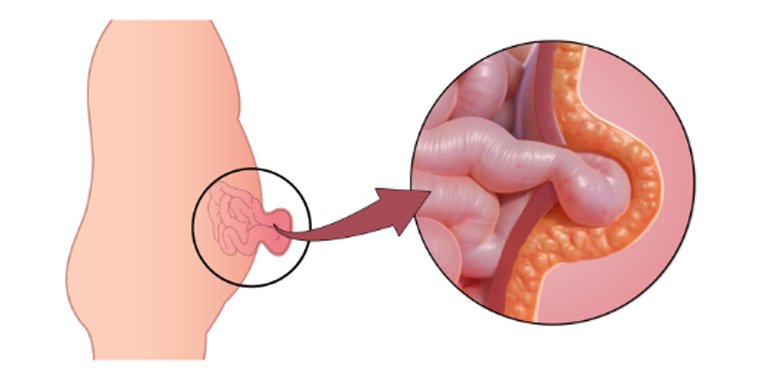 Hernia surgery